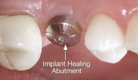 Dental implant healing abutment