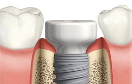 Dental implant healing abutment